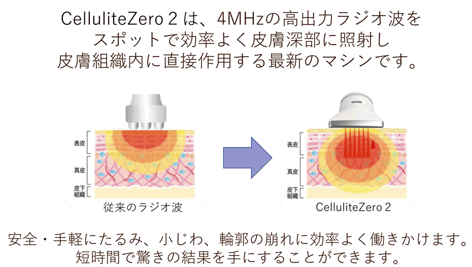 CelluliteZero2は、4MHzの高出カラジオ波をスポットで効率よく皮膚深部に照射し皮膚組織内に直接作用する最新のマシンです。安全・手軽にたるみ、 小じわ、 輪郭の崩れに効率よく働きかけます。短時間で驚きの結果を手にすることができます。