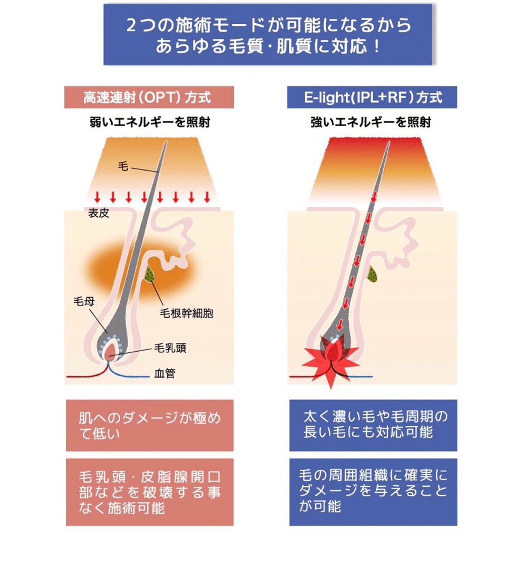 2つの施術モードが可能になるからあらゆる毛質・肌質に対応！ ■高速連写（OPT）方式　肌へのダメージが極めて低い　毛乳頭・皮脂腺開口部などを破壊する事なく施術可能　■E-light(IPL+RF) 方式　太く濃い毛や毛周期の長い毛にも対応可能　毛の周囲組織に確実にダメージを与えることが可能