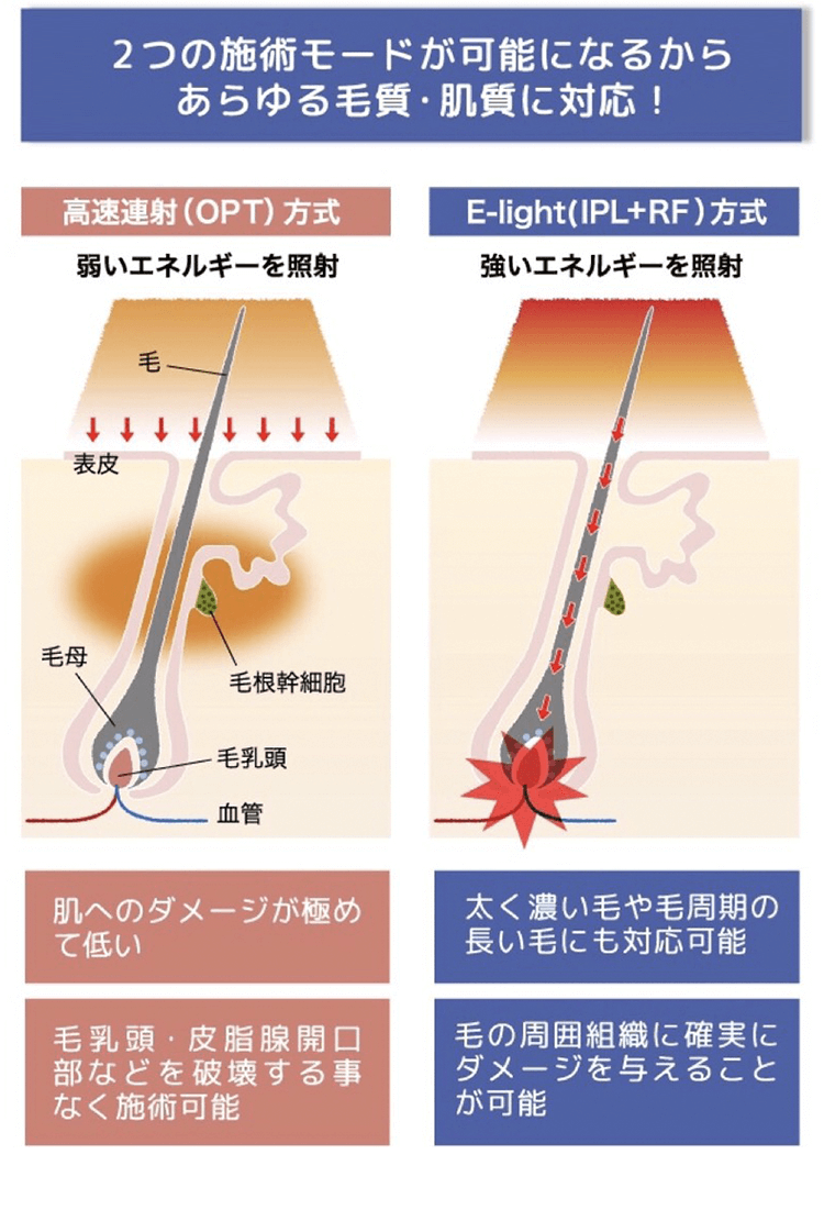 2つの施術モードが可能になるからあらゆる毛質・肌質に対応！ ■高速連写（OPT）方式　肌へのダメージが極めて低い　毛乳頭・皮脂腺開口部などを破壊する事なく施術可能　■E-light(IPL+RF) 方式　太く濃い毛や毛周期の長い毛にも対応可能　毛の周囲組織に確実にダメージを与えることが可能